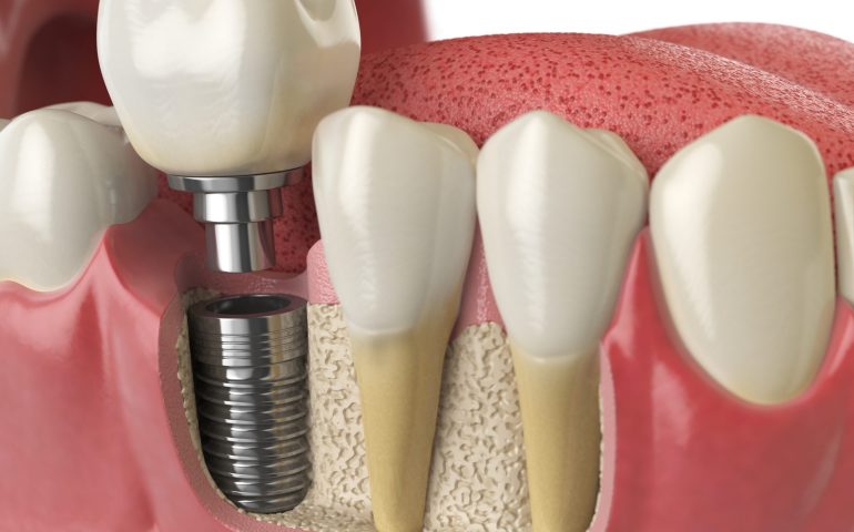Anatomy of healthy teeth and tooth dental implant in human dentu