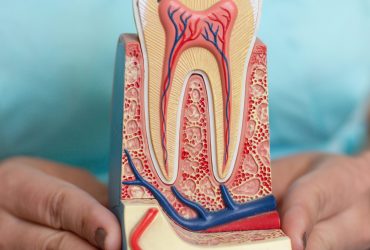 Root Canal