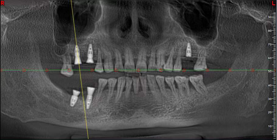 Implant after