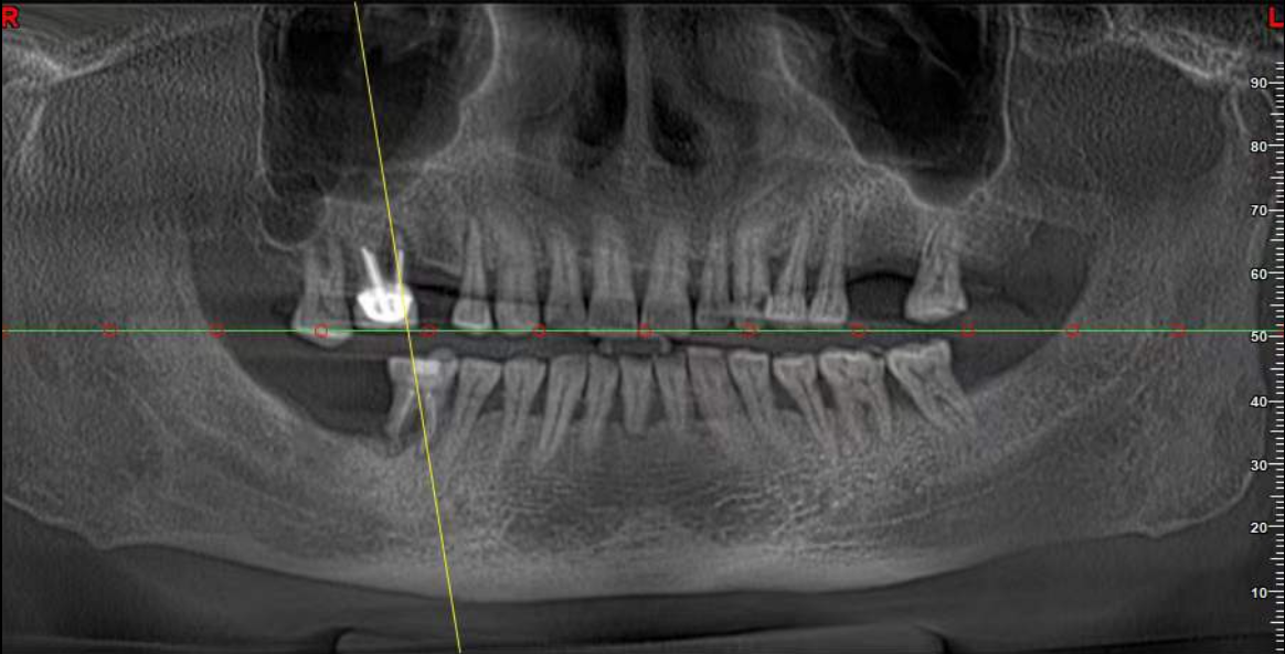 Implant before