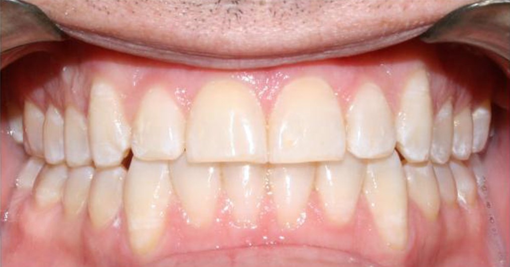 Invisalign After