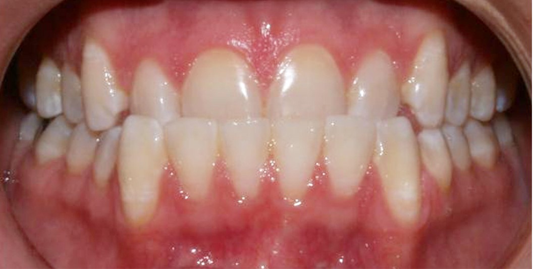Invisalign Before
