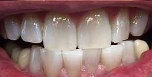 White Zoom After